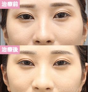 モニター症例№304（27歳 女性）脱脂コンデンスリポ