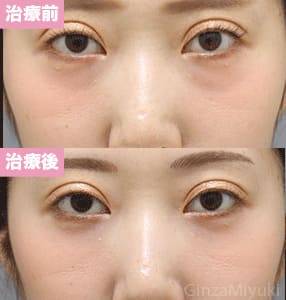 モニター症例№305（31歳 女性）脱脂コンデンスリポ