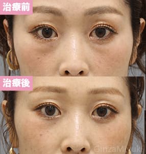 モニター症例№306（37歳 女性）脱脂コンデンスリポ