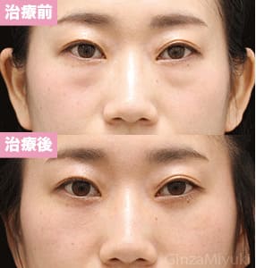 モニター症例№307（29歳 女性）脱脂コンデンスリポ