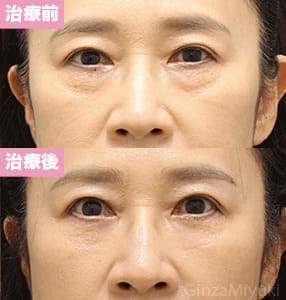 モニター症例№308（57歳 女性）脱脂コンデンスリポ