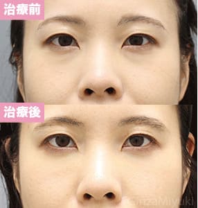 モニター症例№309（30歳 女性）脱脂コンデンスリポ