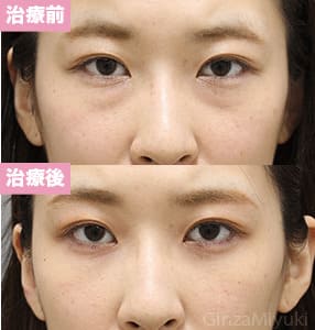 モニター症例№310（28歳 女性）脱脂コンデンスリポ