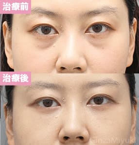 モニター症例№311（34歳 女性）脱脂コンデンスリポ