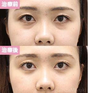 モニター症例№312（24歳 女性）脱脂コンデンスリポ