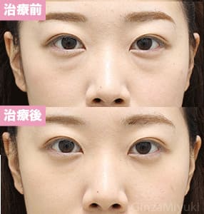 モニター症例№313（24歳 女性）脱脂コンデンスリポ