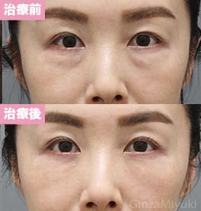 モニター症例№314（46歳 女性）経結膜脱脂