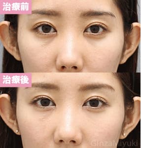 モニター症例№315（28歳 女性）脱脂コンデンスリポ