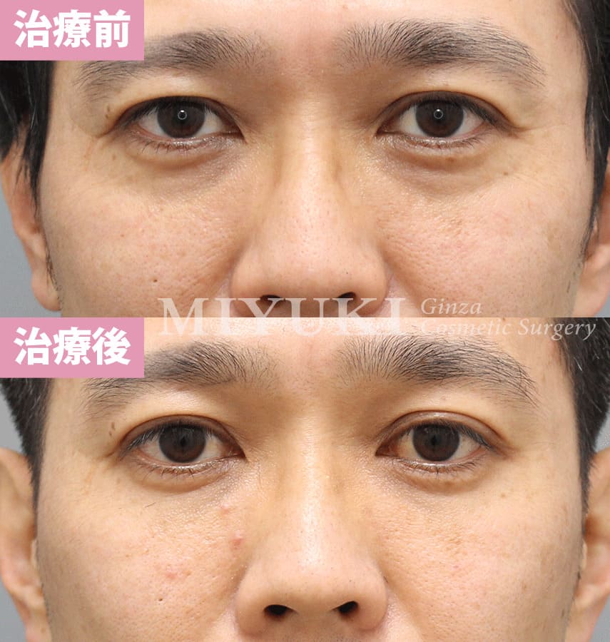 モニター症例№317（44歳 男性）脱脂コンデンスリポ