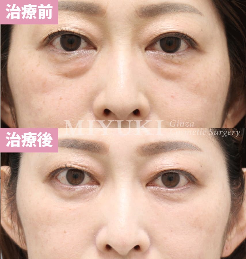 モニター症例№319（46歳 女性）経結膜脱脂