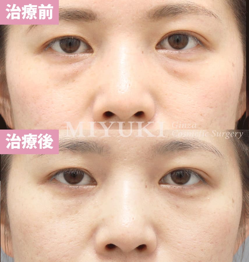 モニター症例№320（37歳 女性）脱脂コンデンスリポ