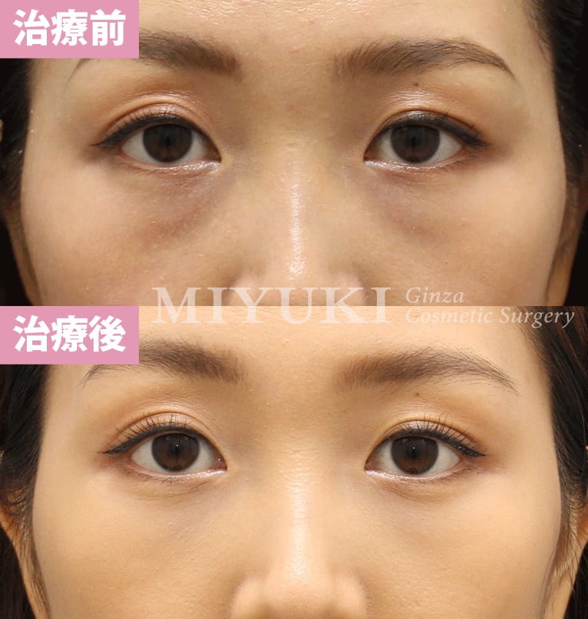 モニター症例№322（33歳 女性）脱脂コンデンスリポ