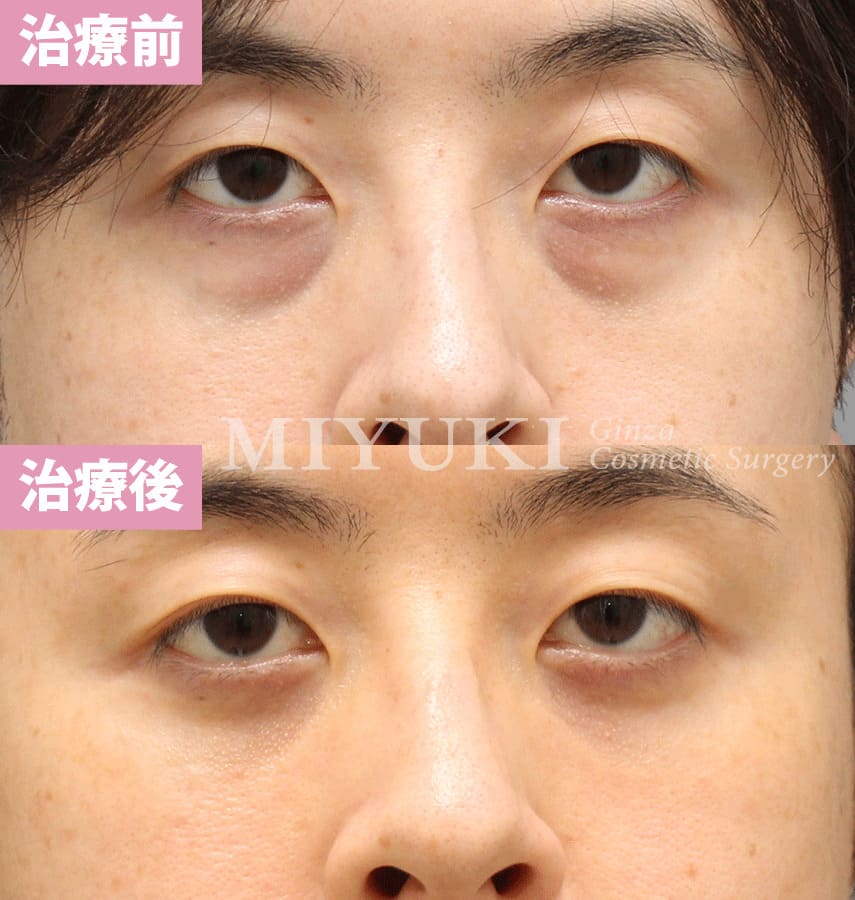 モニター症例№324（32歳 男性）脱脂コンデンスリポ