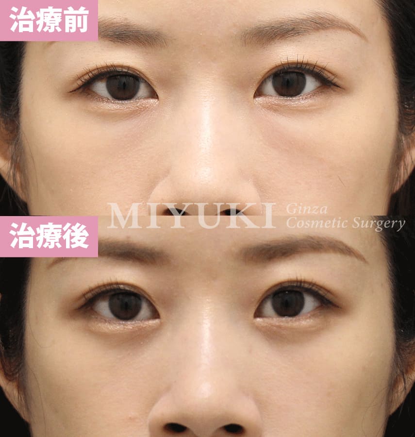 モニター症例№326（27歳 女性）経結膜脱脂