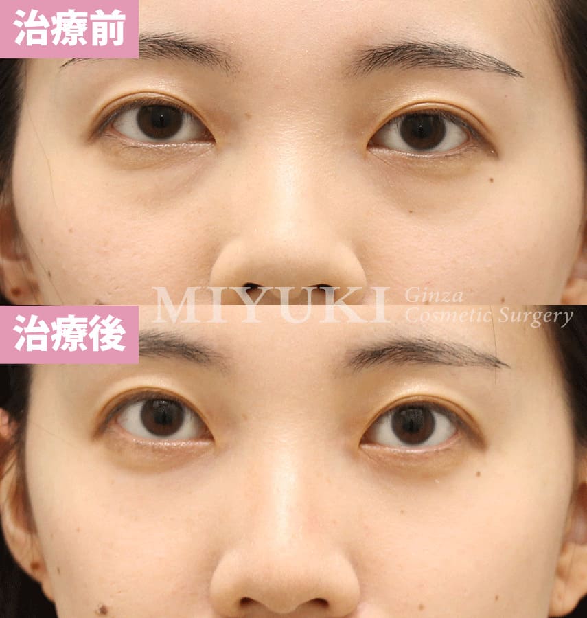 モニター症例№327（25歳 女性）経結膜脱脂