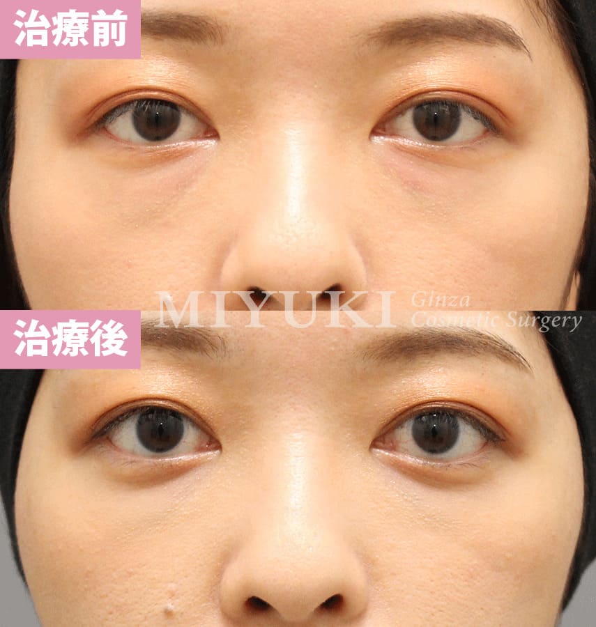 モニター症例№328（30歳 女性）脱脂コンデンスリポ