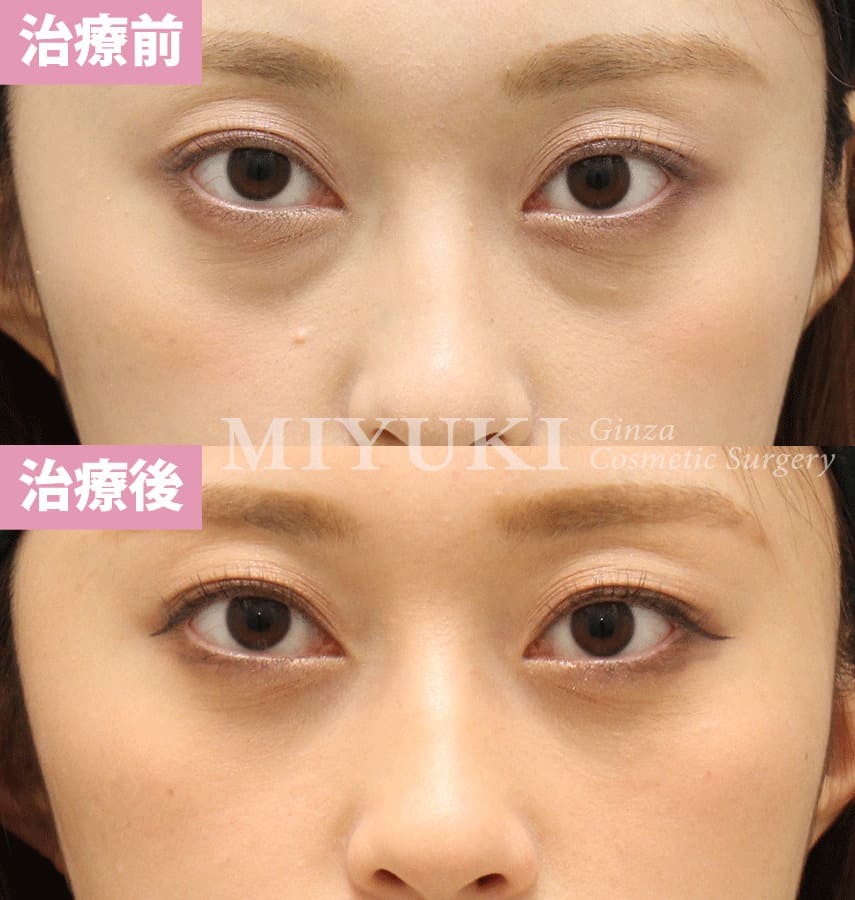 モニター症例№329（23歳 女性）経結膜脱脂