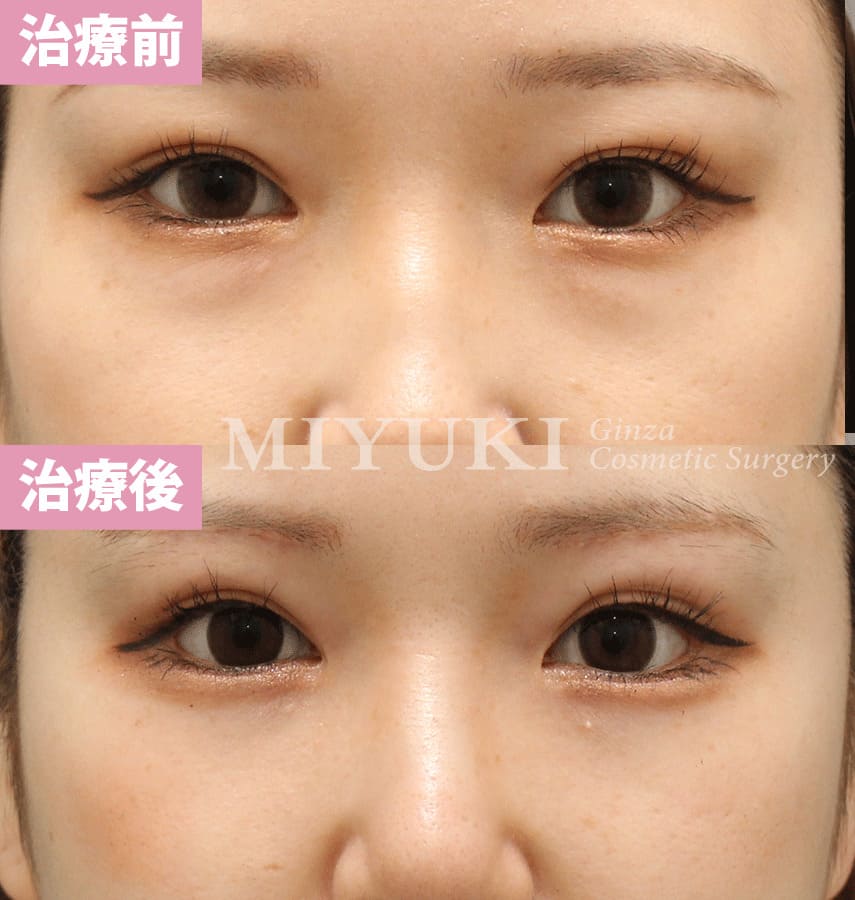 モニター症例№330（21歳 女性）脱脂コンデンスリポ