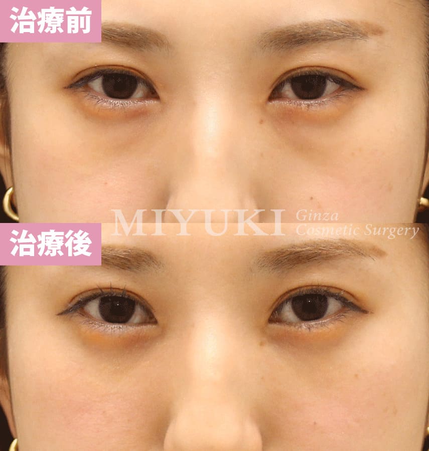 モニター症例№331（27歳 女性）経結膜脱脂