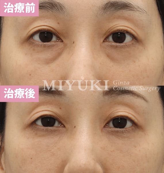 モニター症例№332（44歳 女性）脱脂コンデンスリポ