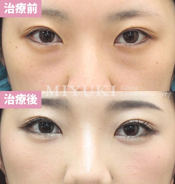 モニター症例№333（22歳 女性）脱脂コンデンスリポ