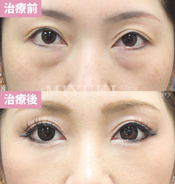 モニター症例№335（36歳 女性）脱脂コンデンスリポ