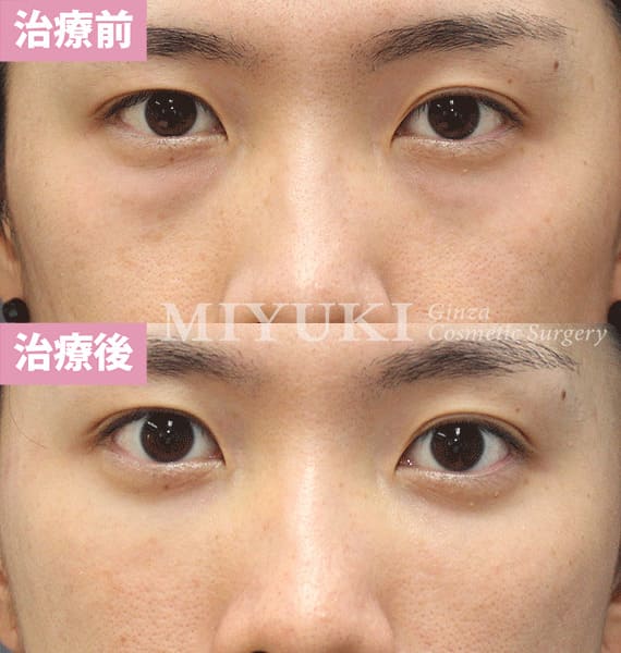 モニター症例№336（30歳 男性）経結膜脱脂