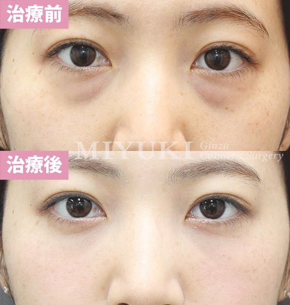 モニター症例№337（24歳 女性）脱脂コンデンスリポ