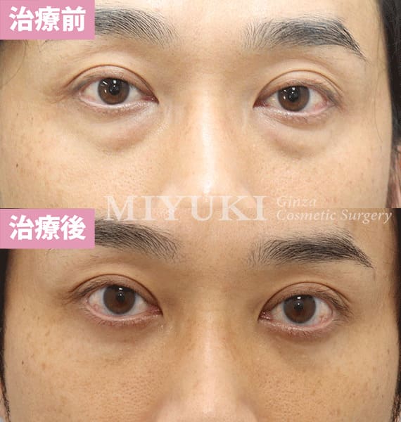 モニター症例№338（38歳 男性）脱脂コンデンスリポ