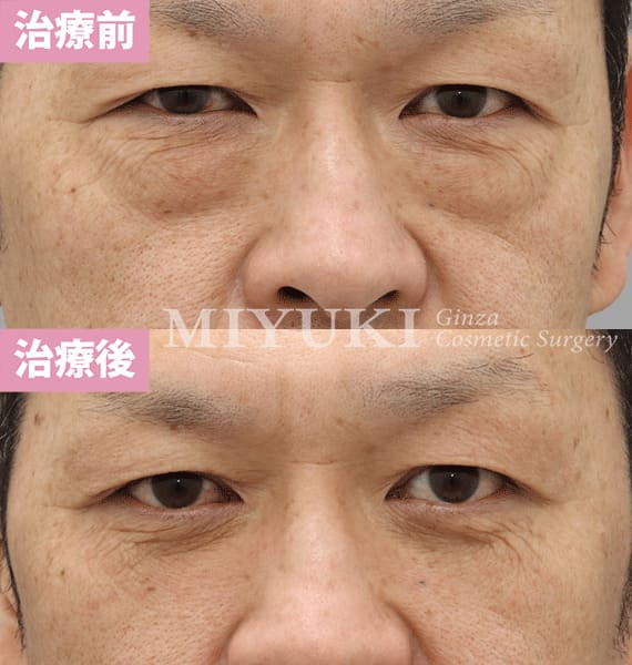 モニター症例№339（48歳 男性）脱脂コンデンスリポ