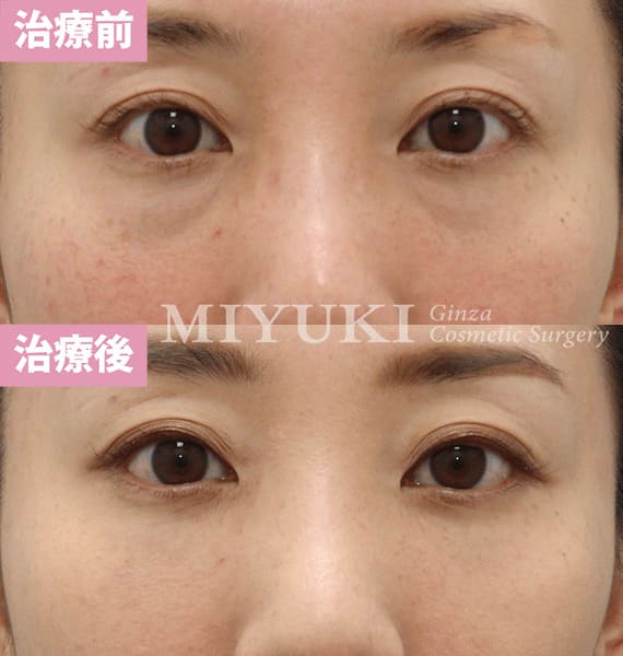 モニター症例№340（38歳 女性）脱脂コンデンスリポ