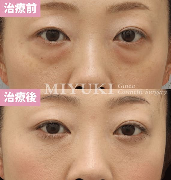 モニター症例№342（38歳 女性）脱脂コンデンスリポ