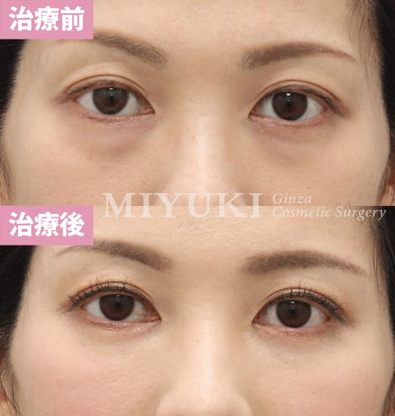 モニター症例№343（34歳 女性）脱脂コンデンスリポ