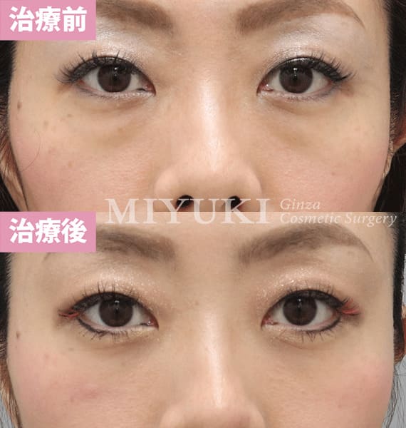 モニター症例№344（36歳 女性）脱脂コンデンスリポ