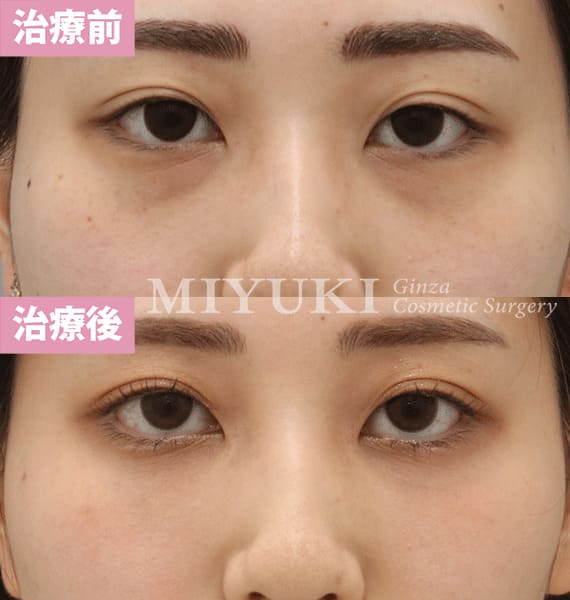 モニター症例№346（21歳 女性）脱脂コンデンスリポ