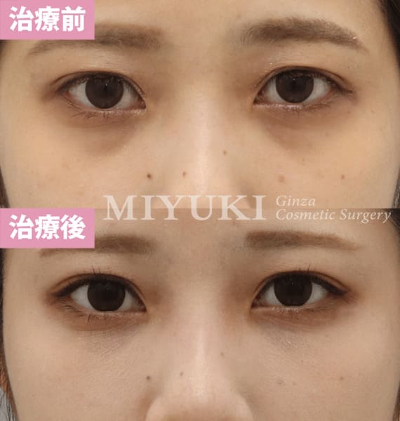 モニター症例№347（23歳 女性）脱脂コンデンスリポ