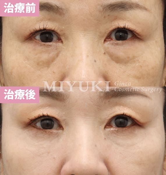 モニター症例№348（61歳 女性）脱脂コンデンスリポ