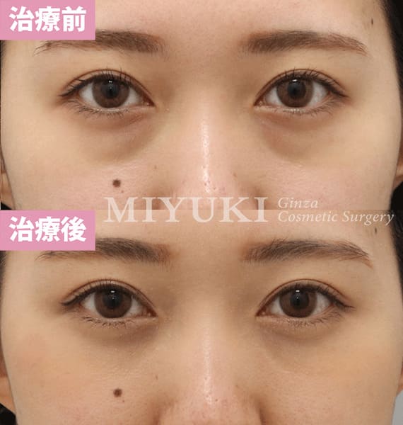 モニター症例№349（22歳 女性）脱脂コンデンスリポ