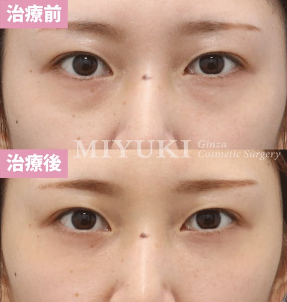 モニター症例№351（27歳 女性）脱脂コンデンスリポ