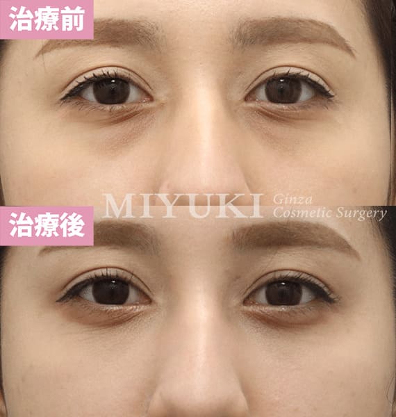 モニター症例№353（23歳 女性）脱脂コンデンスリポ