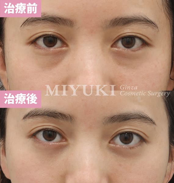 モニター症例№354（28歳 女性）脱脂コンデンスリポ