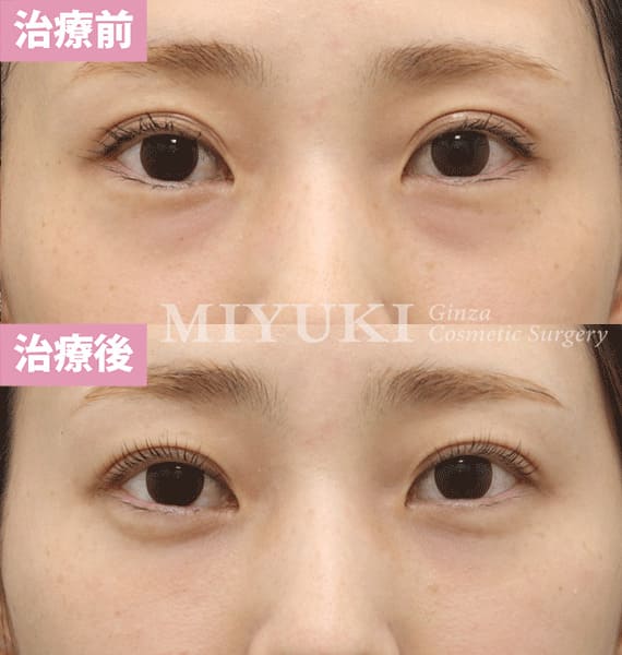 モニター症例№355（34歳 女性）脱脂コンデンスリポ