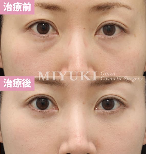 モニター症例№356（36歳 女性）脱脂コンデンスリポ