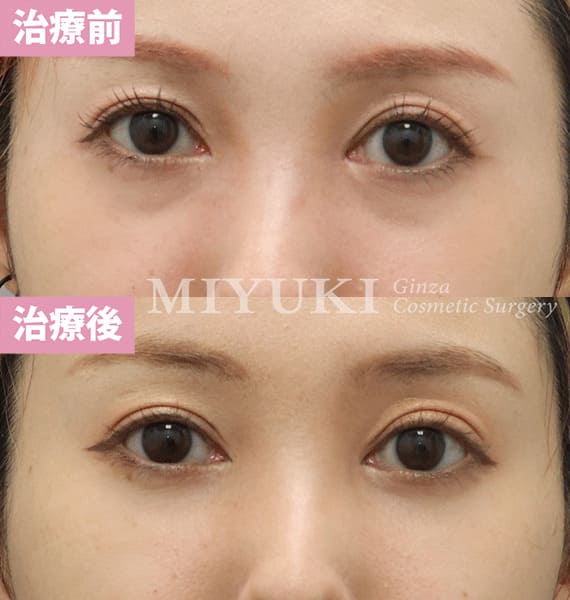 モニター症例№357（33歳 女性）脱脂コンデンスリポ