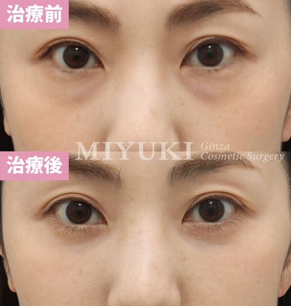 モニター症例№358（37歳 女性）脱脂コンデンスリポ