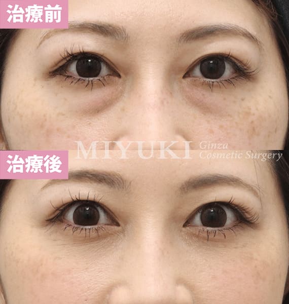 モニター症例№359（33歳 女性）脱脂コンデンスリポ