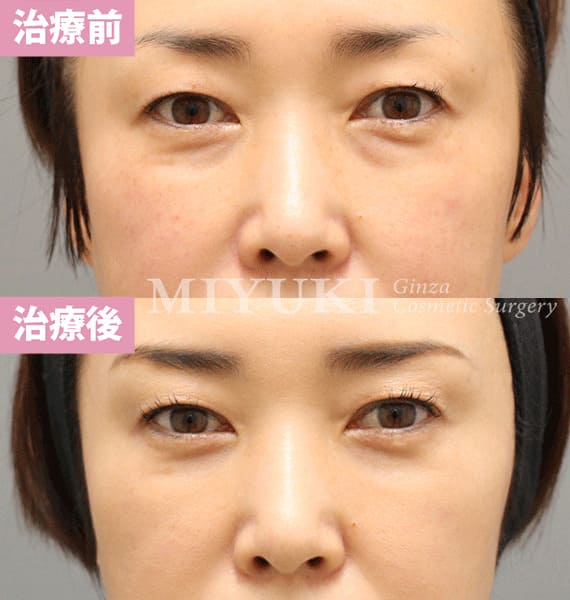 モニター症例№360（48歳 女性）脱脂コンデンスリポ