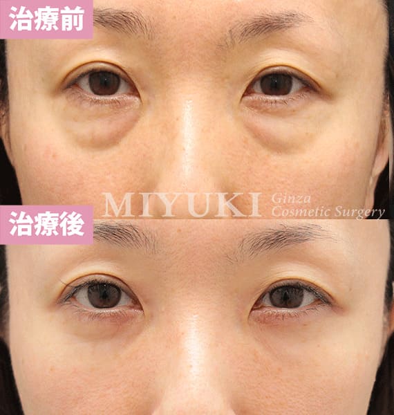 モニター症例№361（43歳 女性）脱脂コンデンスリポ