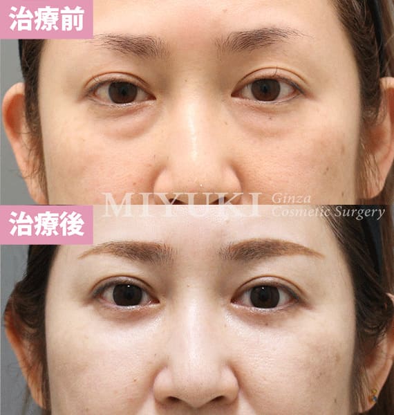 モニター症例№362（45歳 女性）脱脂コンデンスリポ