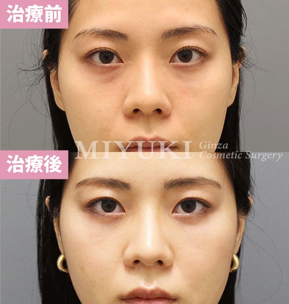 モニター症例№364（30歳 女性）脱脂コンデンスリポ